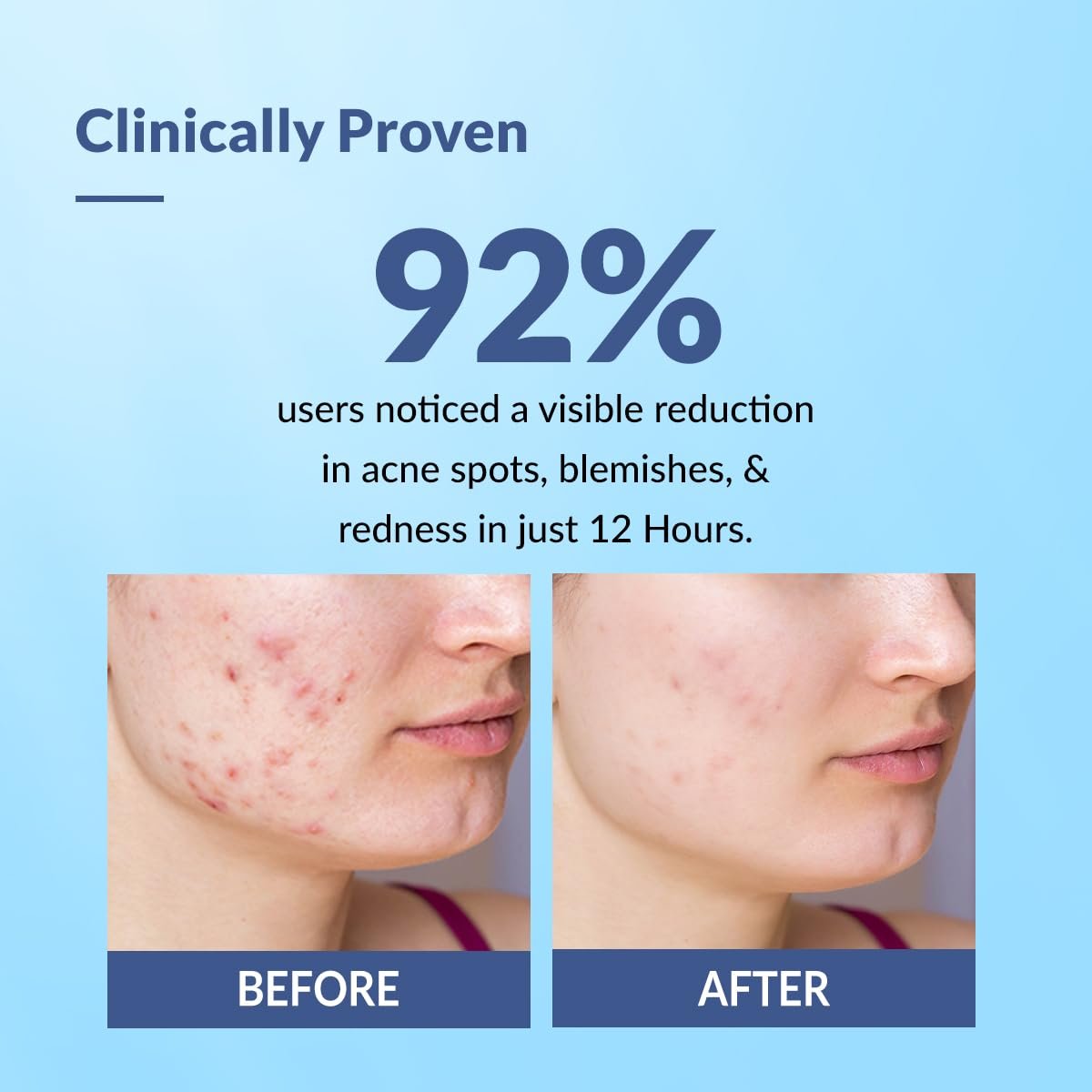 Fixderma Salyzap 2% Salicylic Acid Acne Spot Corrector Gel with 2% Niacinamide Acid & 1% Aczero | Reduce Active Acne & Redness | Fades Dark Spots & Blemishes | Pimple Remover For Men & Women - 20g - Image 2