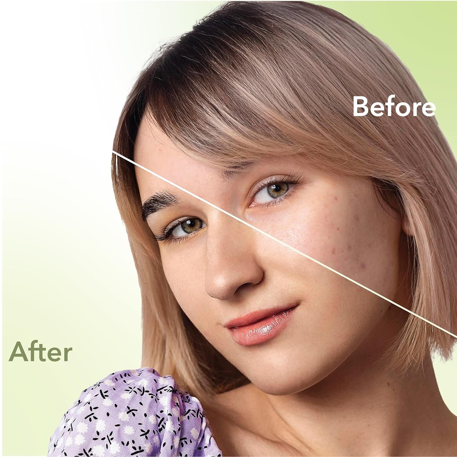 DR.RASHEL Neem Acne Pimple Patch with Salicylic Acid, Hydrocolloid Patches for Zits and Blemishes, 36 Patches - Image 2